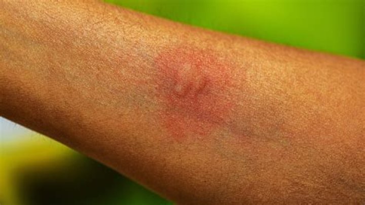 Are mosquito bites harmful or just annoying?