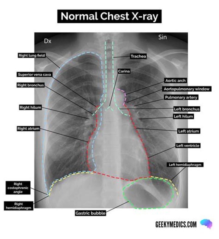 Chest 1