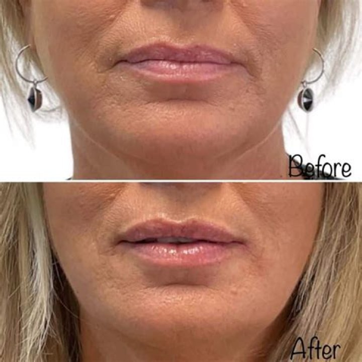 Fillers