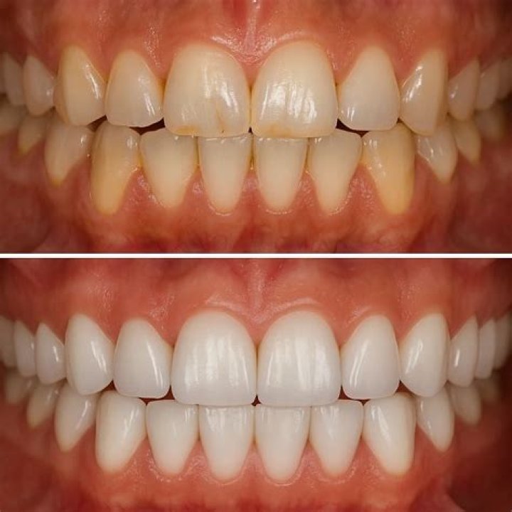 What is sound occlusion?